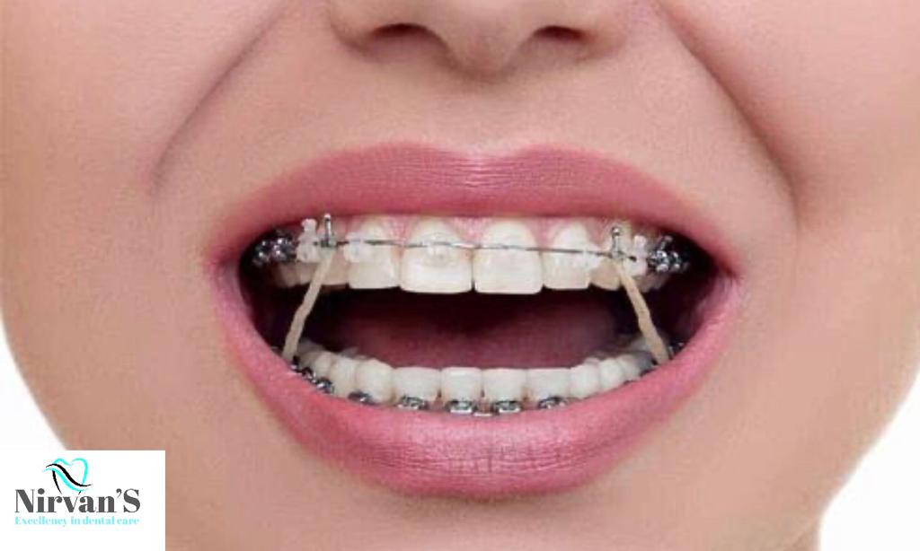 Braces and orthodontic treatment