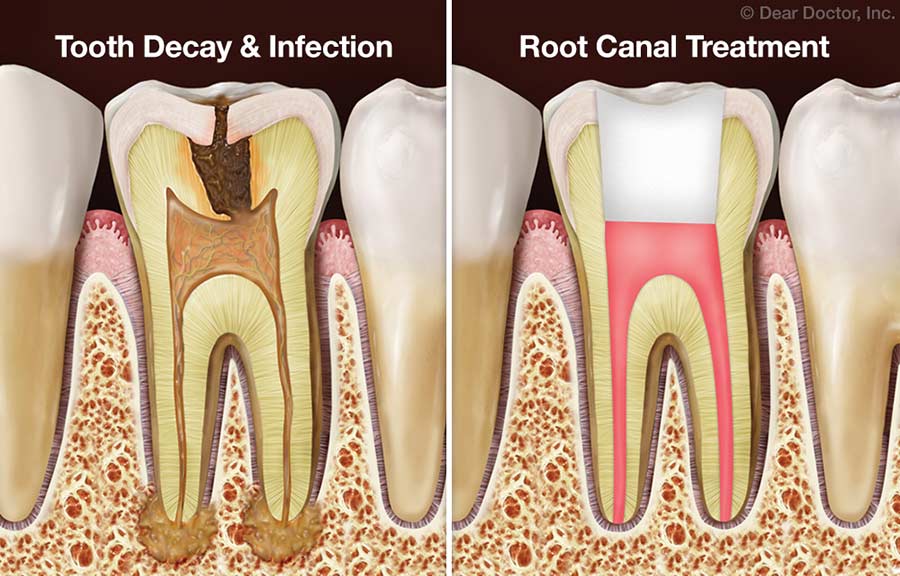 Root canal treatment