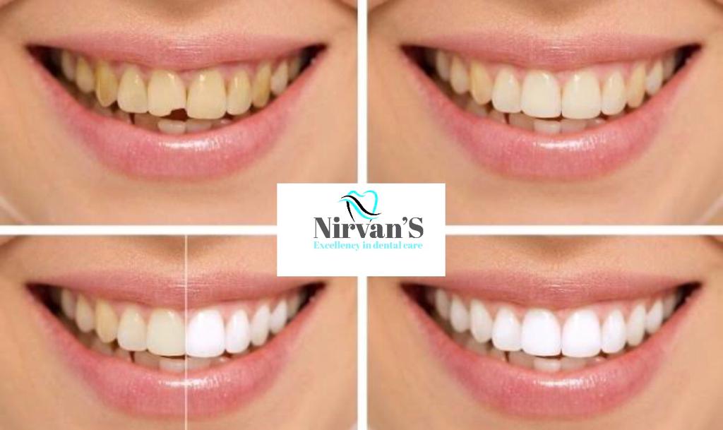 Smile makeover